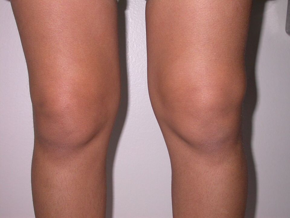 Knieschwellung durch Arthrose