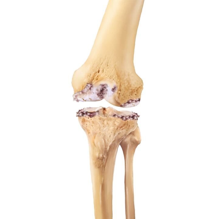 Zerstörung des Kniegelenks mit Arthrose