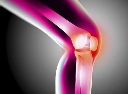 Verformung Arthrose