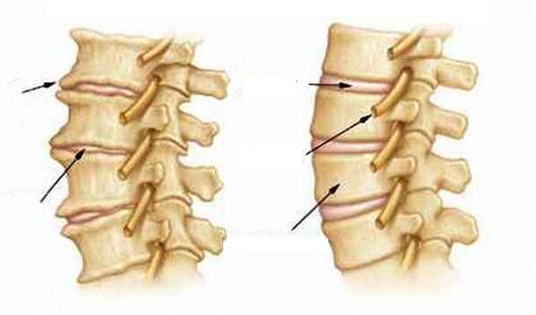 Was ist Osteochondrose