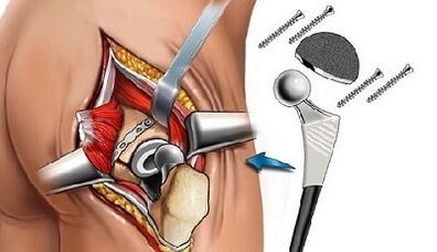 Endoprosthetik für Hüftarthrose