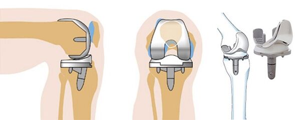 Endoprothetikbetrieb des Kniegelenks für Arthrose