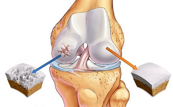 Norm und Abweichung zur Arthrose des Kniegelenks
