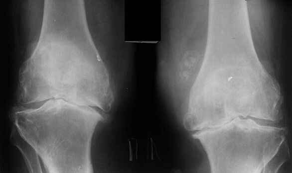 X -Ray als Mittel zur Diagnose der Arthrose des Kniegelenks