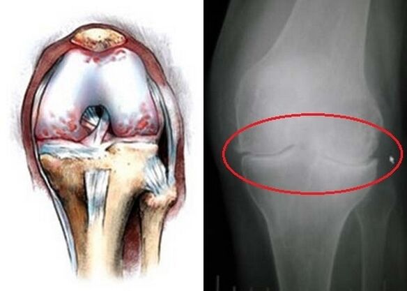 Die Verformung des Kniegelenks zur Arthrose