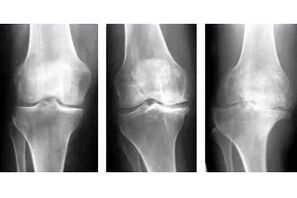 Stadien der Arthrose des Gelenks auf einer Röntgenaufnahme