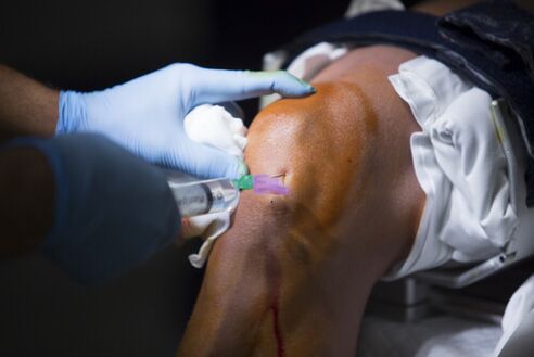 Injektionen in das Kniegelenk bei Arthrose